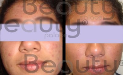 antes y después del tratamiento para piel grasa