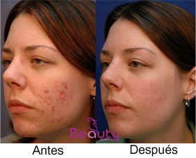 Tratamiento para el Acne