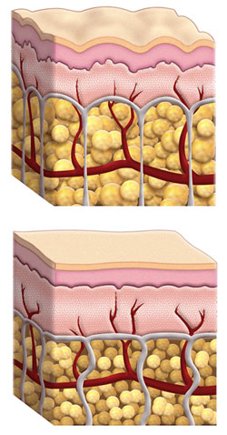 Celulitis