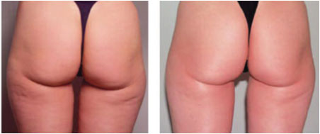 Mesoterapia sin Inyecciones ni Medicamentos