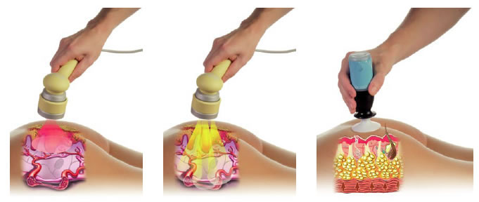 Mesoterapia Virtual