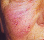 rosacea