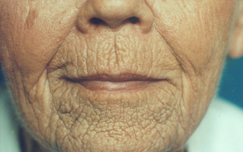 piel asfictica envejecida