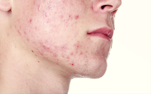 tratamiento para el acné y piel grasa