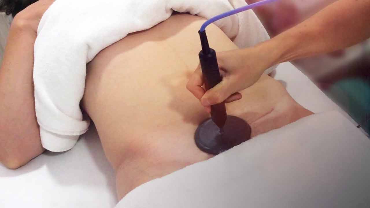 tratamientos para cicatriz de cesárea