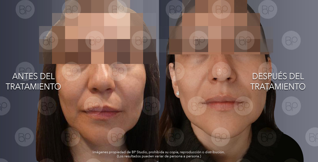 tratamientos post-lifting facial