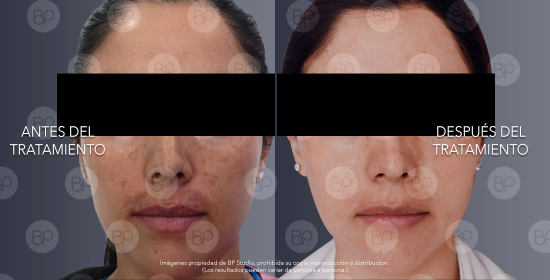 tratamientos paño facial