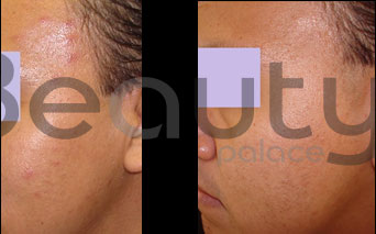 antes y después del tratamiento para piel grasa