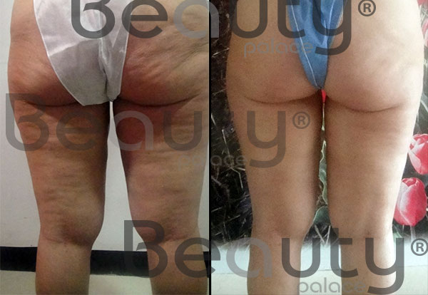 antes y después de tratamiento anti-celulitis