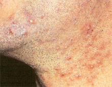 Vellos enterrados Foliculitis